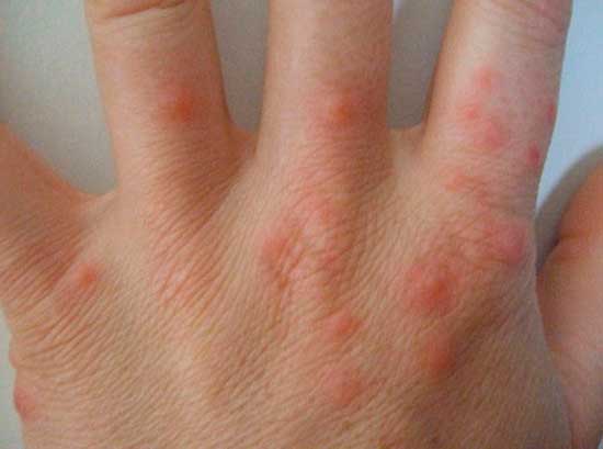Воспаления от укусов клопов на руке у человека