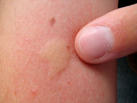 Аллергическая реакция на укус комара - припухлость и покраснение кожи