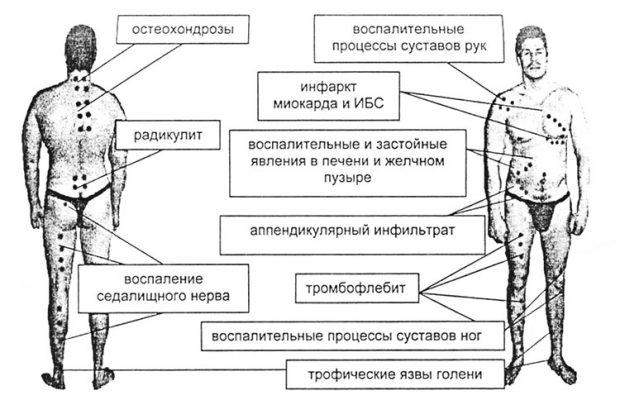 Схема лечения укусами пчел