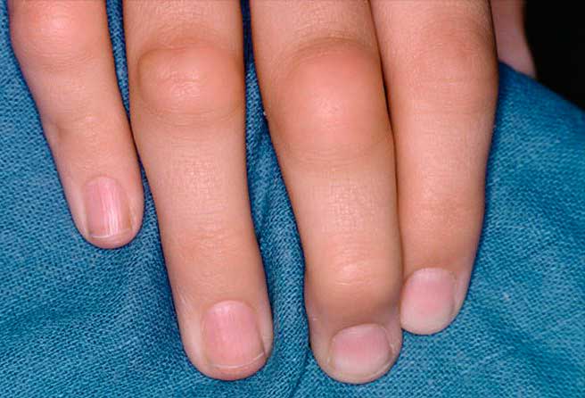 Артрит пальцев кистей рук при хроническом боррелиозе