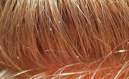 Гниды в волосах человека - как отличить от перхоти